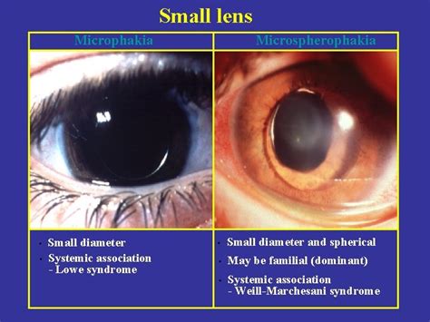 Diseases Of The Lens Prof Dr Raciha Beril