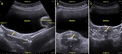 Comparison Of Measurements Of The Uterus And Cervix Obtained By