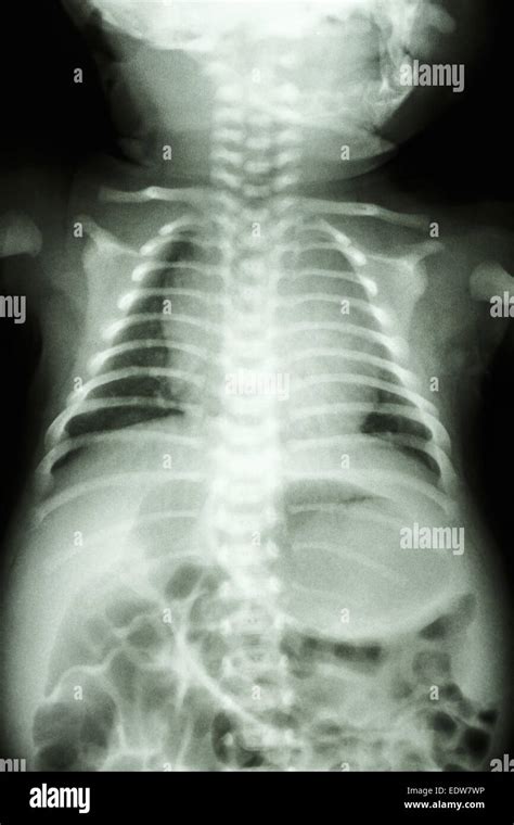 Film X Ray Show Normal Chest Of Infant Stock Photo Alamy