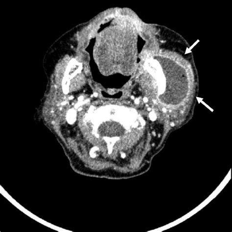 Ct Scan Image Showing Abscess Formation Over The Left Ramus Mandibulae