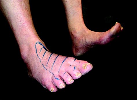Foot drop: where, why and what to do? | Practical Neurology