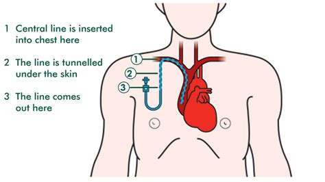 Tunneled Catheter Newest Information