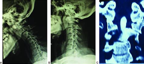 Lateral Flexion Extension Radiographs A And B And Coronal