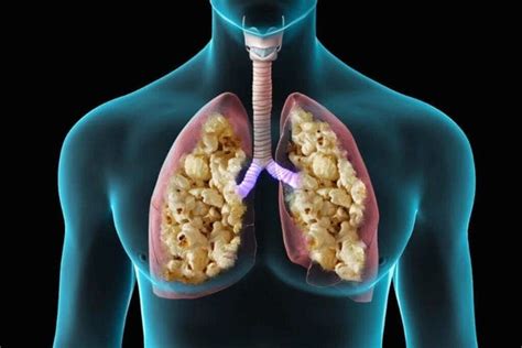 Popcorn Lung And Vaping Symptoms And Signs