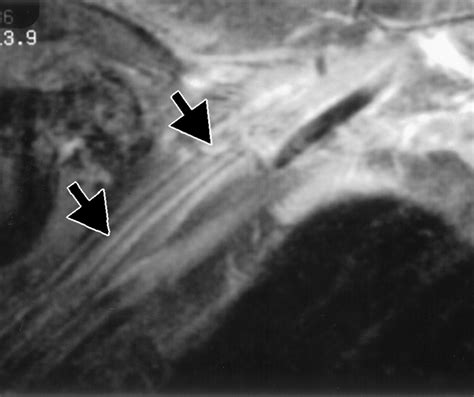 Navigating The Thoracic Inlet Radiographics