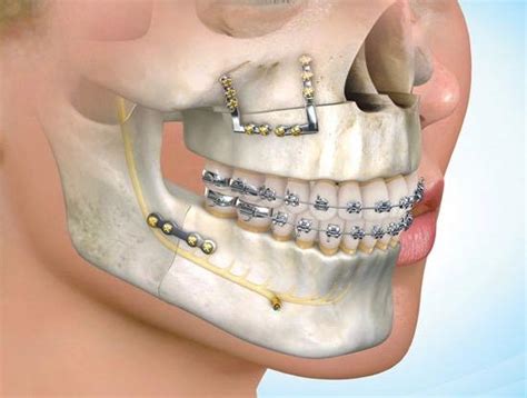 Orthognathic Surgery Cameron Dental Center