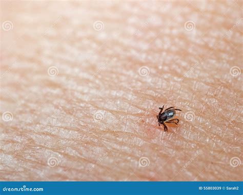Tick With Head Buried In Human Leg Skin Stock Image Image Of Disease