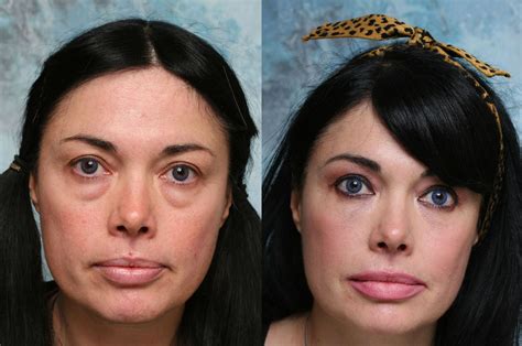 Remove Eye Bags Practicing Key Facial Gymnastics And Eye Exercises Under Eye Wrinkles Face
