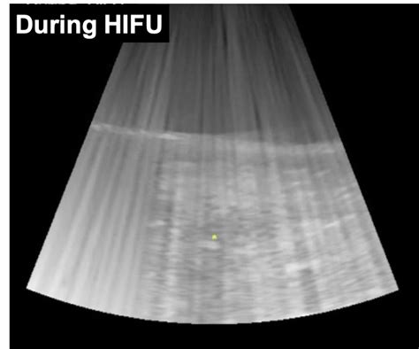 Hifu High Intensity Focused Ultrasound Therapy Saisei Immunotherapy Clinics