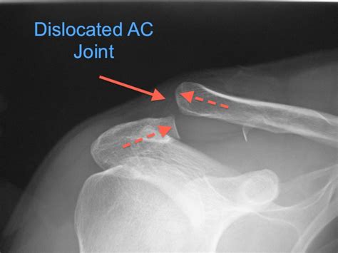 Acromioclaivicular Joint Dislocation Dr Terry Hammond