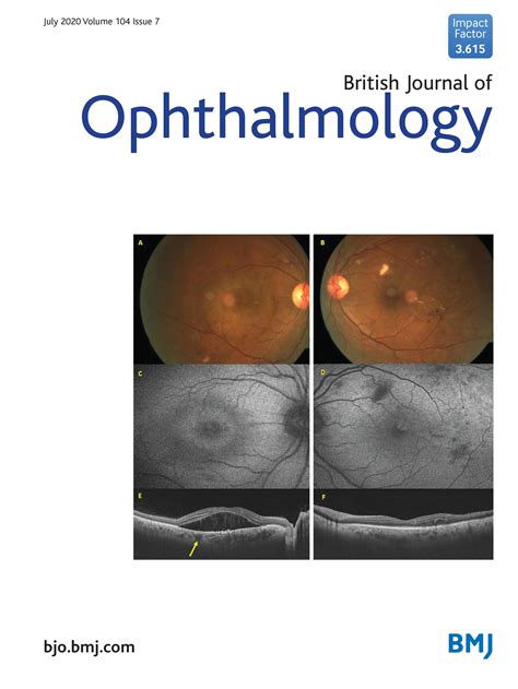 Low Dose 001 Atropine Eye Drops To Reduce Progression Of Myopia In