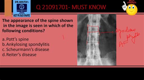 Ankylosing Spondylitis Bamboo Spine