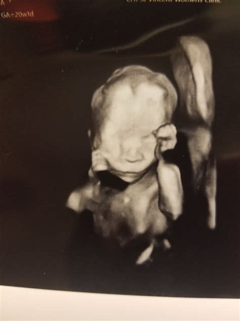 Post Your Ultrasounds Here Page 6 — The Bump