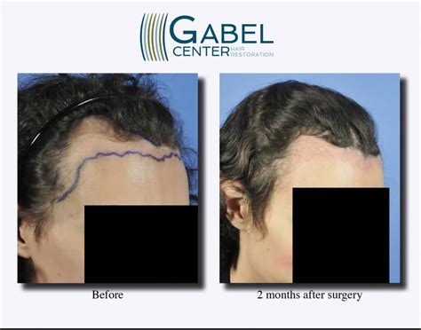 My 6 month hair growth progress after a 2 day fue hair transplant procedure with dr raghu reddy in london.the hair transplant procedure. Hair Transplant Growth Timeline - Gabel Hair Restoration ...