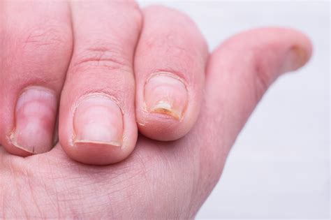How To Treat Psoriasis Of The Nail Bed Nail Ftempo