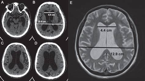 Normal Pressure Hydrocephalus In Down Syndrome The Report Of Two Cases IOS Press