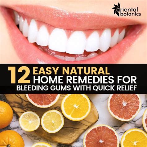 12 Easy Natural Home Remedies For Bleeding Gums With Quick Relief