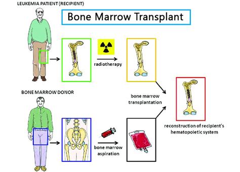 Bone Marrow Bone Marrow Transplantation Pictures