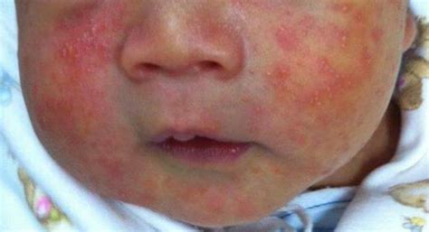 My Baby Is Having Lots Of Rashes On His Theasianparent