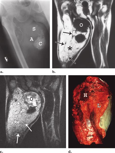 Dedifferentiated Liposarcoma Of The Thigh In A 72 Year Old Man With A