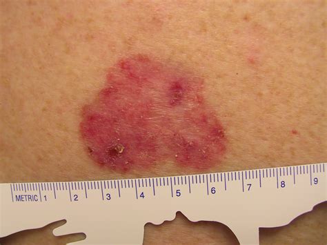 Squamous Skin Cell Cancer