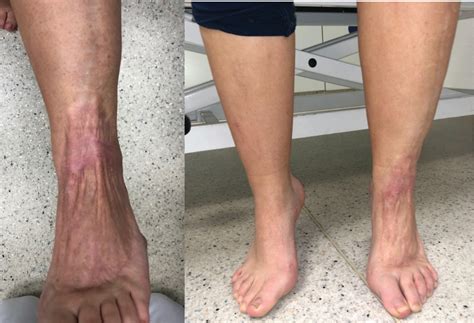Aggressive Necrotizing Fasciitis In A 12 Year Old Girl Of Unknown