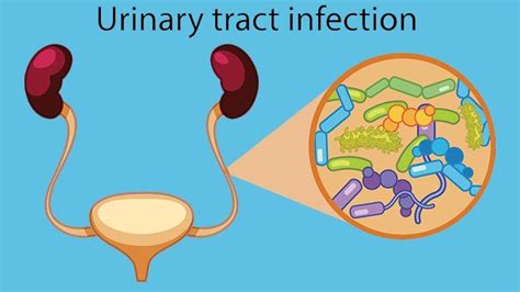 Urinary Tract Infection World Of Health
