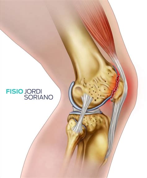 Tendinitis Rotuliana S Ntomas Y Tratamiento Fisio Jordi Soriano