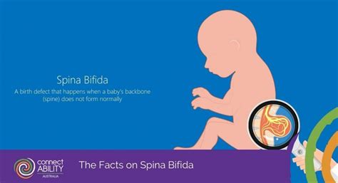 The Facts On Spina Bifida Connectability Australia