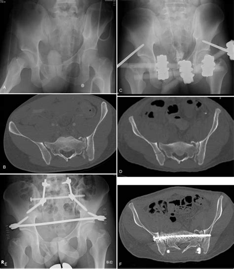 Minimally Invasive Triangular Osteosynthesis For Highly Unstable Sacral