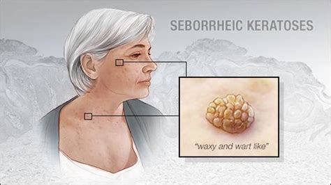 Mayo Clinic Q And A What Are Seborrheic Keratoses Mayo Clinic News Network