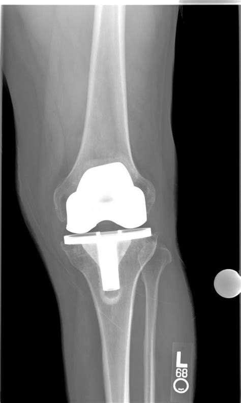 Knee Prosthesis 1 Buyxraysonline
