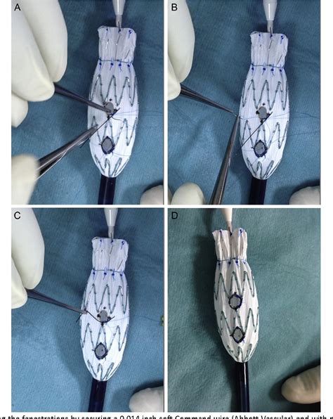 Figure 1 From Surgeon Modified Fenestrated Endovascular Abdominal