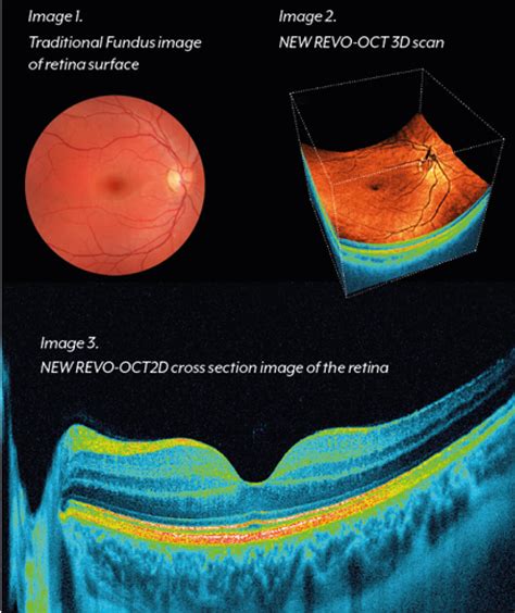 Oct Retinal Digital Imaging Feltham Eyecare Centre