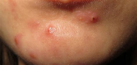 Cystic Acne On Chin Deep Painful Causes And Treatments Skincarederm