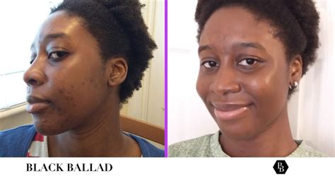 Dealing With The Physical And Emotional Effects Of Acne As A Dark Skinned