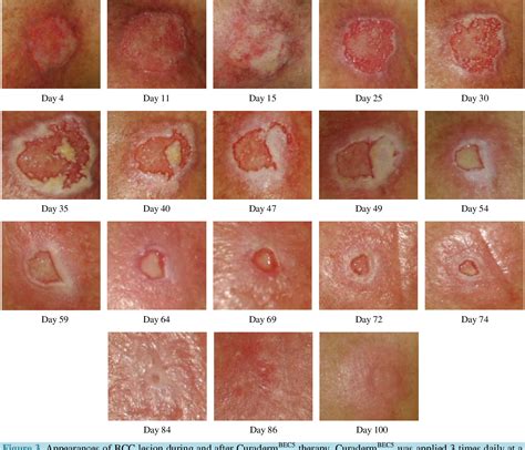 Figure 2 From Treatment Of Skin Cancer With A Selective