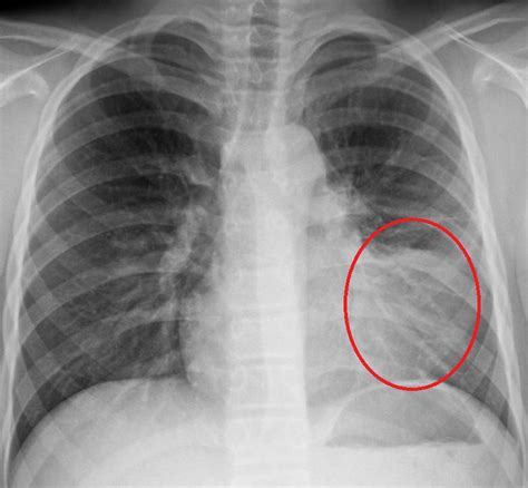The chest x ray is one of the most common imaging tests performed in clinical practice,.patients who present with suspected pneumonia sometimes undergo both chest x ray (cxr) and computed tomography (ct). Post-Operative Pneumonia - TeachMeSurgery