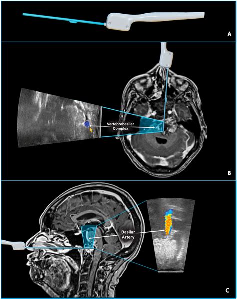 frontiers case report side firing intraoperative ultrasound guided endoscopic endonasal