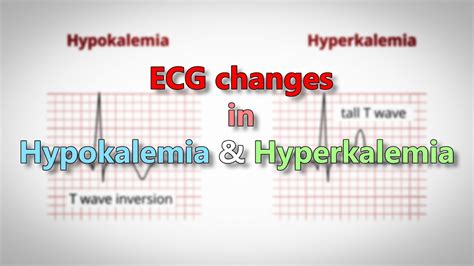 Hypokalemia And Hyperkalemia Ecg Changes Youtube