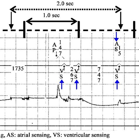Ecg Of The Pacemaker Which Observed Oversensing In Ecg One Pacemaker