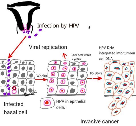 Pin On Hpv Infection