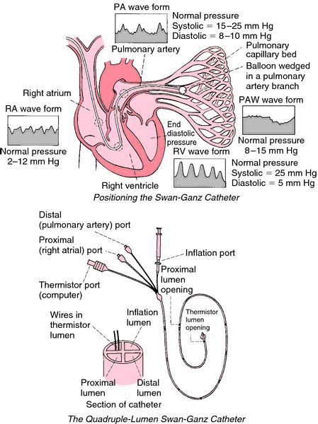 Image Result For Pulmonary Artery Catheter Icu Nursing