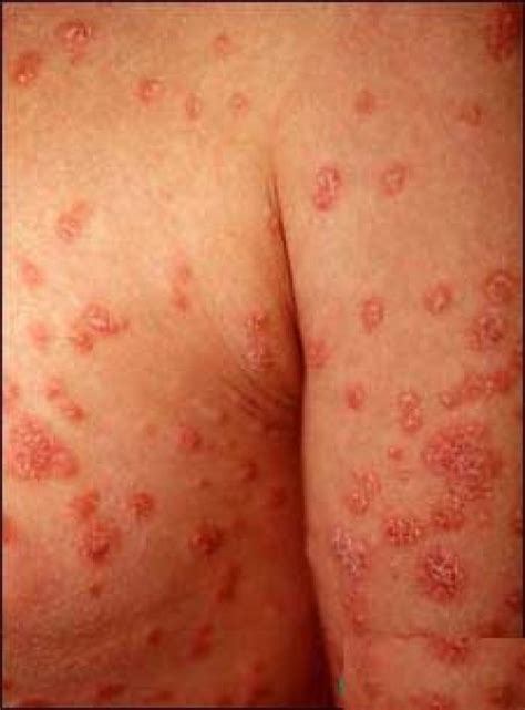 Psoriasis Eczema Treatment Dorothee Padraig South West Skin Health Care