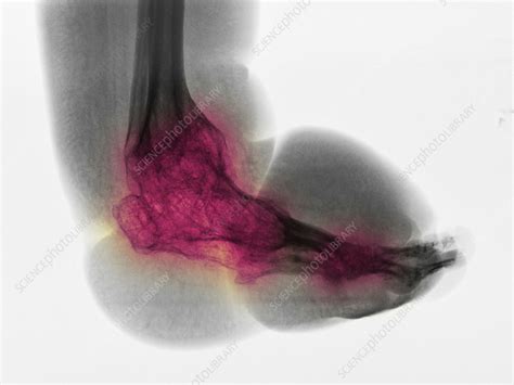 Severe Bone Degeneration In 63 Year Old Patient Stock Image C009