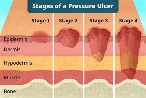 Pressure Ulcer Bedsore Treatment For Stages Through