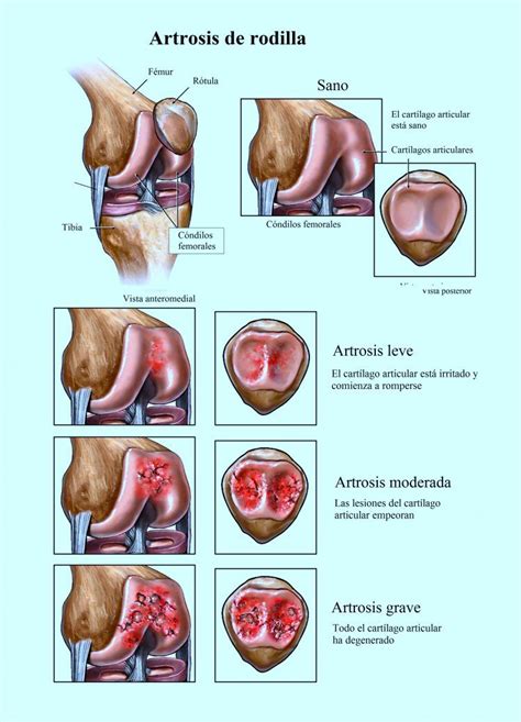 el dolor de rodilla puede estar causado por una lesión como por ejemplo la rotura de un li