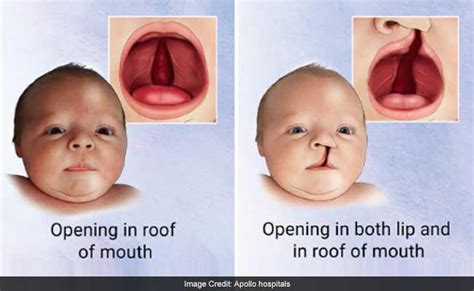 Cleft Lip And Palate Surgery Pictures