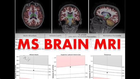 Understand Your Brain Scan Ms Mri Youtube