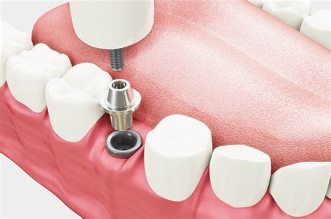 Tipos de implantes dentales CLÍNICA MAESTRO Oviedo